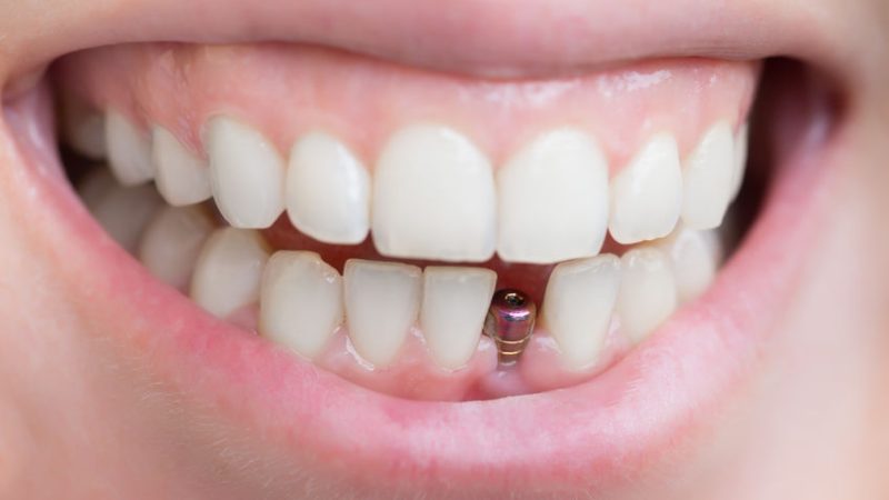 Tout savoir sur l’implant dentaire : solutions, prix et déroulement