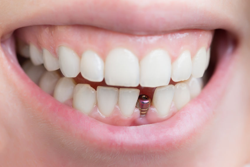 Tout savoir sur l’implant dentaire : solutions, prix et déroulement
